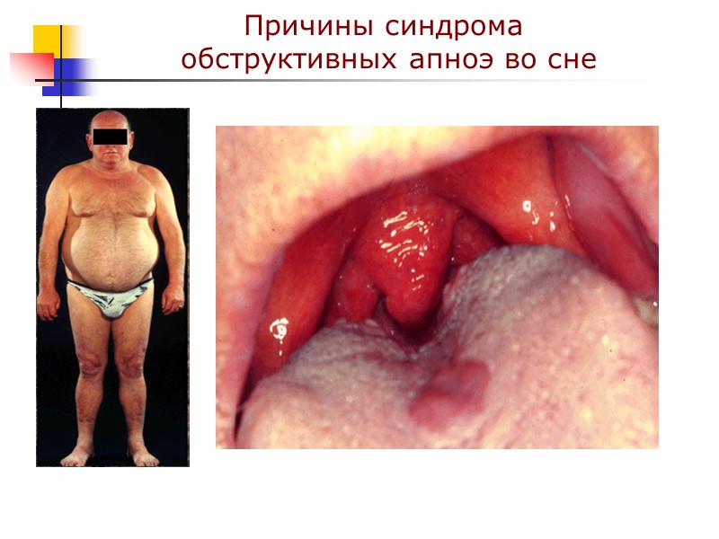 Причины синдрома  обструктивных апноэ во сне